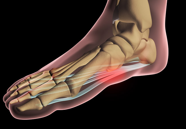 plantar fasciitis