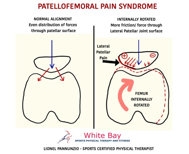 Patellofemoral Pain Syndrome Anatomy