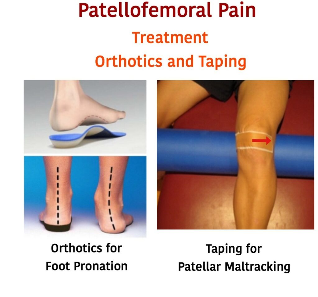 Patellofemoral Pain Syndrome Orthotics ans taping