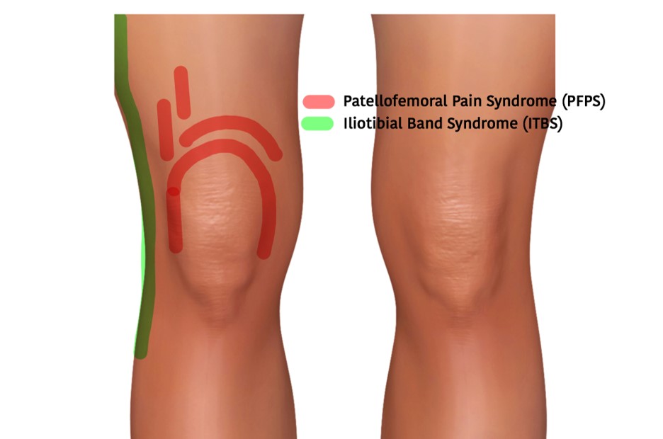 Patellofemoral Pain Syndrome